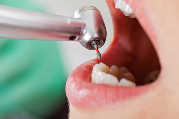 Best Emergency Tooth Extraction in Granger, IA